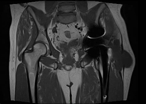 A 40-Year-Old Man with Increasing Hip Pain - JBJS Image Quiz