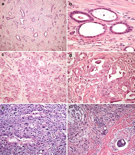 a, b Well-differentiated (glandular score 3), low grade tubular cancer... | Download Scientific ...