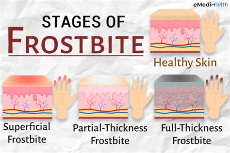 Frostbite Stages, Prevention and Treatment - eMediHealth