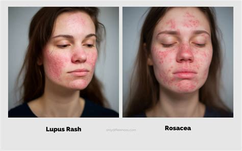 Lupus Rash vs Rosacea: What's the Difference? (2024)