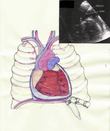 Safety, Efficacy, and Complications of Pericardiocentesis by Real-Time Echo-Monitored Procedure ...