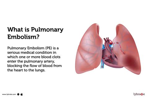 Pulmonary Embolism: Causes, Symptoms, Treatment and Cost