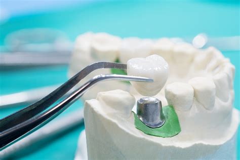 What is a Dental Crown Restoration? - Hemet Dental Center: Brian Stiewel DDS, INC. Hemet California