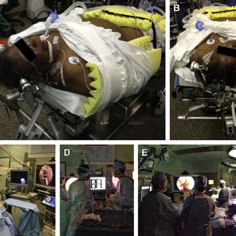 Patient and room positioning. (A, B) Patient positioning. The head is ...