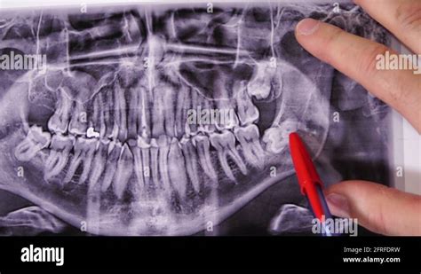 Wisdom teeth x ray Stock Videos & Footage - HD and 4K Video Clips - Alamy