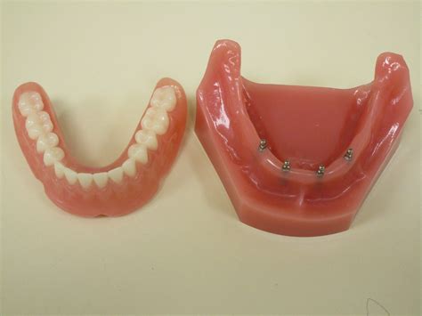 Mini Dental Implants