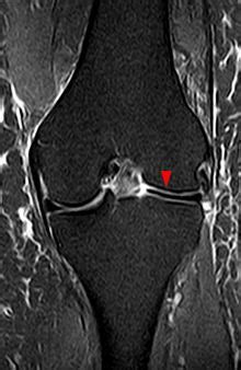 Discoid meniscus - Physiopedia