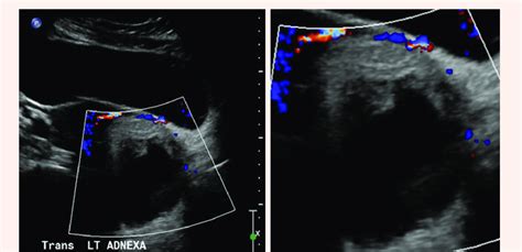 Pelvic ultrasound showing Complex left adnexal mass measuring ...