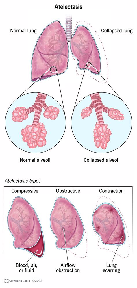 Atelectasis: Causes, Symptoms, Diagnosis & Treatment