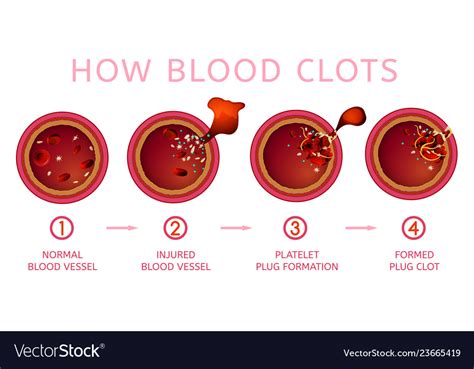 The Diagram Shows Three Steps In The Clotting Process Coagul