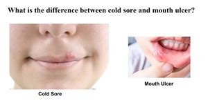 What is the difference between cold sores and mouth ulcers? | News ...