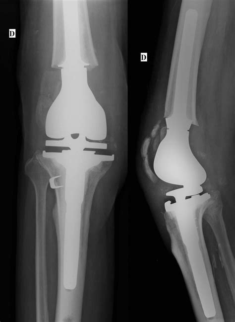 Distal Femoral Reconstruction Following Failed Total Knee, 52% OFF