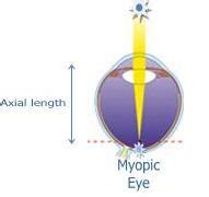 Exploring the world of vision: Refractive disorders: Myopia or Nearsightedness (1). Vision and ...