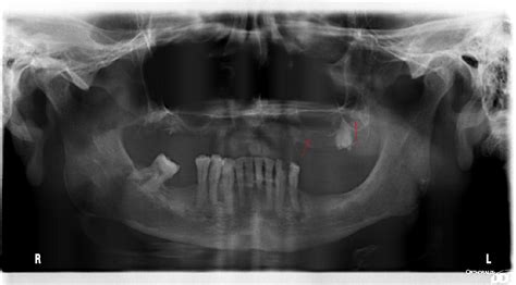 Figure 2 from Iatrogenic fracture of the maxillary tuberosity – a case report | Semantic Scholar