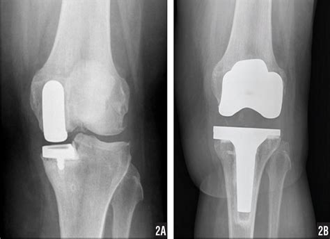 What Complications May Occur During And After Knee Arthroscopy? | DocOPD