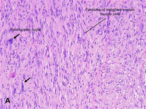 American Urological Association - Leiomyosarcoma