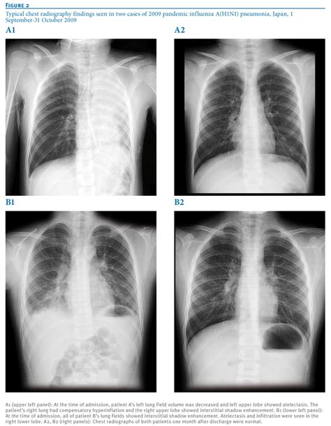 Difference Between Viral And Bacterial Pneumonia X Ray Bronchitis | My ...