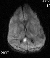 Diffuse Axonal Injury-MRI - Sumer's Radiology Blog