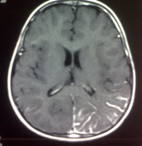 Sturge Weber Syndrome-MRI - Sumer's Radiology Blog