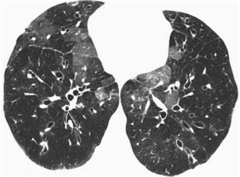 Bronchiolitis Obliterans; late disease, extensive bronchiectasis and mosaic perfusion Sonography ...