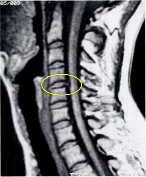 Cervical Spine - Journal club Archives - The Pain Source