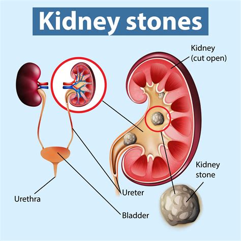 Kidney Stones - Dr Brojen Barman