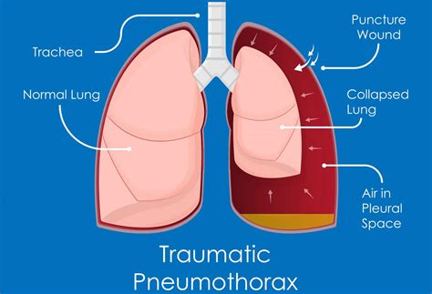 Acute Respiratory Distress Syndrome (ARDS) and Blunt Force Trauma