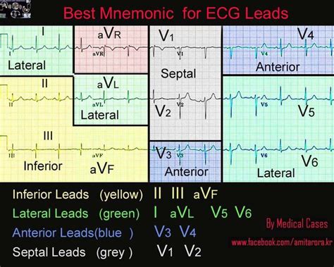 12 lead ECG | Nursing mnemonics, Emergency nursing, Ecg nursing