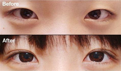 Double Eyelid Surgery in Korea: What You Need to Know - JIVAKA.CARE