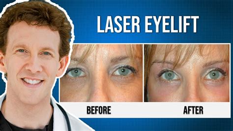 What is a Laser Eyelift and How Does it Work? - YouTube