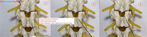 Lumbar/Thoracic Epidural Catheter Insertion – Technique and Overview - The Procedure Guide