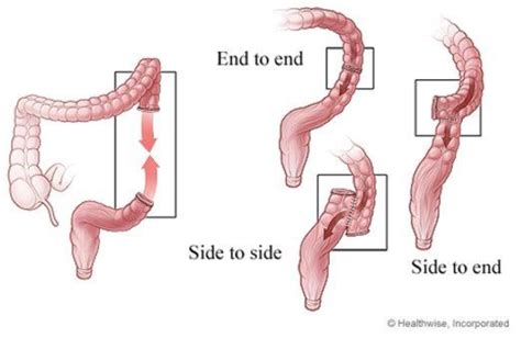 Types of anastomosis (with permission from ©Healthwise, Incorporated ...