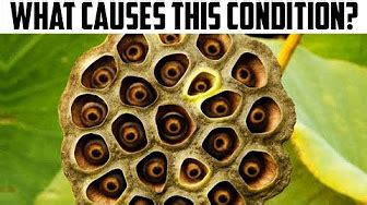 Trypophobia - Cysts, Boils, Pimples and the Fear of Holes - YouTube