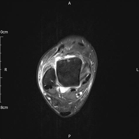 Acute complete anterior talofibular ligament tear | Image | Radiopaedia.org