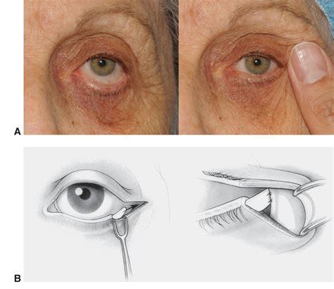 Eyelid Anatomy — Ophthalmology Review