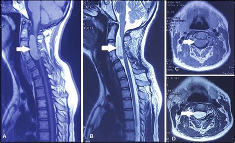 Magnetic resonance imaging of spine showing neurenteric cyst (white ...