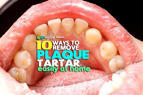 10 Easy Ways to Remove Plaque and Tartar from Teeth At Home Naturally - Natural Home Remedies ...