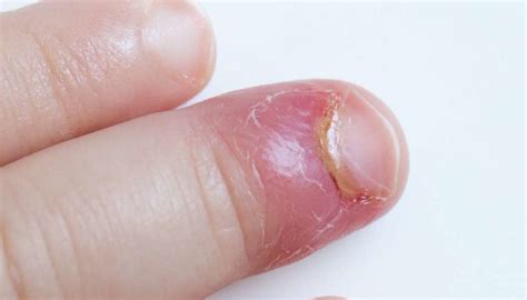 Paronychia: Causes and treatment of an infected nail