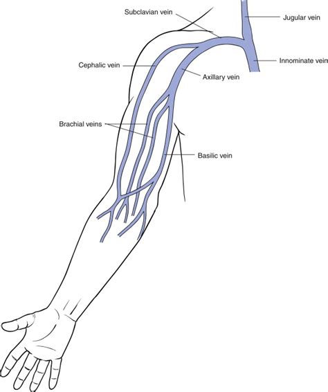 Endovascular Therapy for Subclavian-Axillary Vein Thrombosis | Thoracic Key