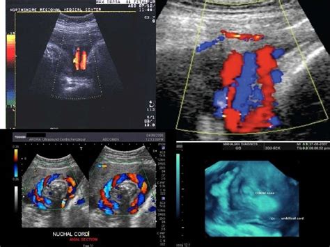 Dilemmas In The Management Of Nuchal Cord