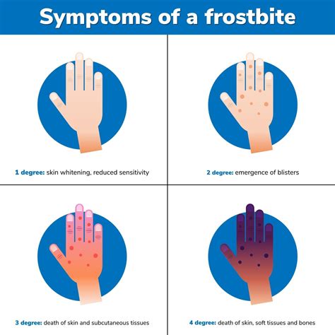 Simptoms of a frostbite 4 medical stages Infographic 2396603 Vector Art at Vecteezy