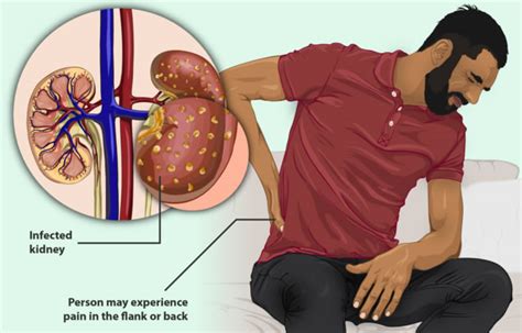 Signs of a Kidney Infection | Wellspire Medical Group