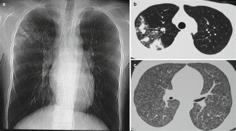 Pulmonary Tuberculosis | Radiology Key