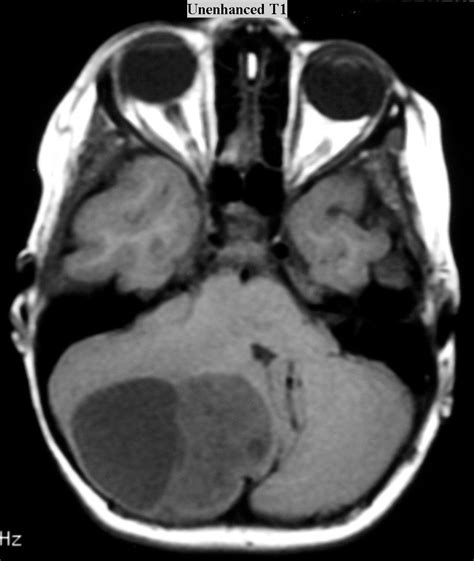 Glioma: Juvenile Pilocytic Astrocytoma Glioma