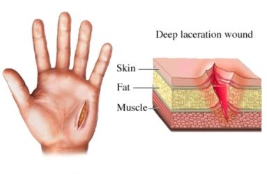 Laceration Repair | UVA Health