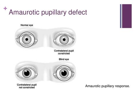 Afferent Pupillary Defect Pathway