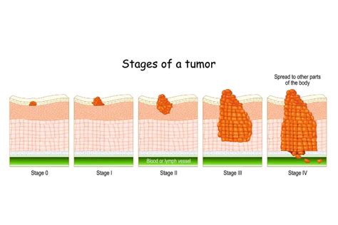 What Are the 4 Stages of Cancer? – ActiveBeat – Your Daily Dose of ...