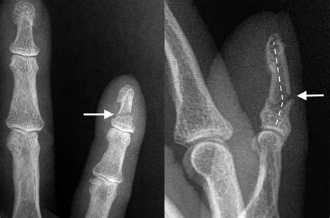 FINGER DISTAL PHALANX FRACTURES | Hand Surgery Resource