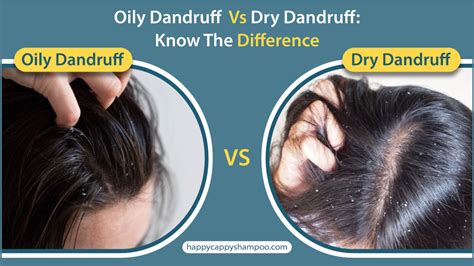 Oily Dandruff Vs Dry Dandruff: Know The Difference