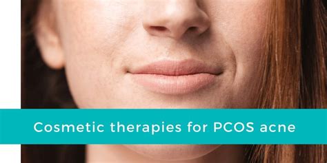 PCOS Acne Treatment | Conquer Your PCOS Naturally